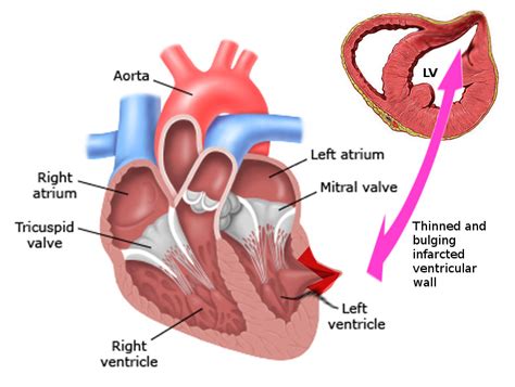 left ventricular aneurysm vs pseudoaneurysm